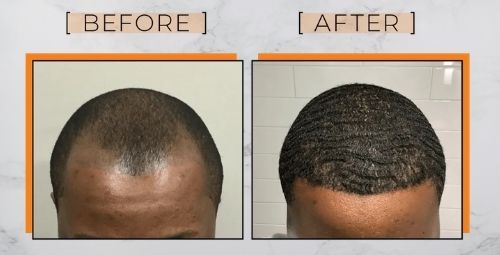Black Men Hair Transplant Fue Before After Nhp 